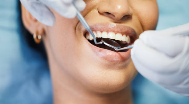Best Dental Abscess Treatment in Castle Rock, WA